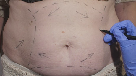 Marking abdomen before liposuction surgery