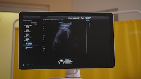 Ultrasound scan on a monitor