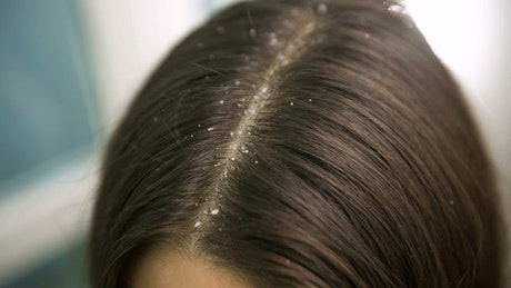 Woman with dandruff in hair, close up.